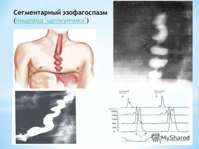 Диффузный эзофагоспазм. Эзофагоспазм пищевода. диффузный спазм пищевода. диффузный и сегментарный эзофагоспазм. дистального эзофагоспазм.