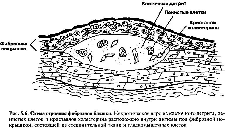 Тканевой детрит это. Патогенез атеросклероза патанатомия. Атеросклероз микропрепарат гистология. Переваримая растительная клетчатка. Детрит.