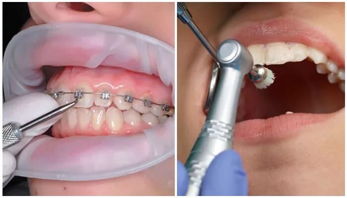 Металлические брекеты. Брекеты фото. Вычет за брекеты ребенку. Вычет за брекеты ребенку. Вычет за брекеты ребенку.