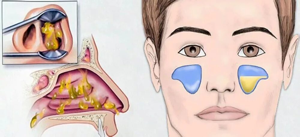 Запах простуды в носу. Гайморит фронтит этмоидит. Аллергический этмоидит. Острый экссудативный риносинусит. Гнойный верхнечелюстной синусит.