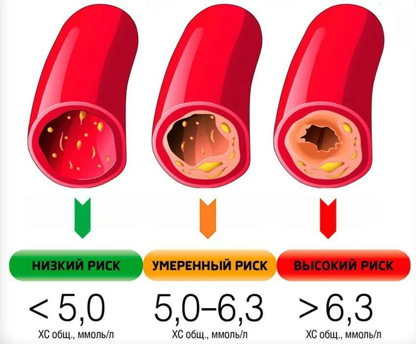 Какой холестерин при атеросклерозе. Повышение глюкозы и холестерина в крови. атеросклероз сосудов показатели крови. повышен уровень холестерина в крови. нестенозирующий атеросклероз артерий.