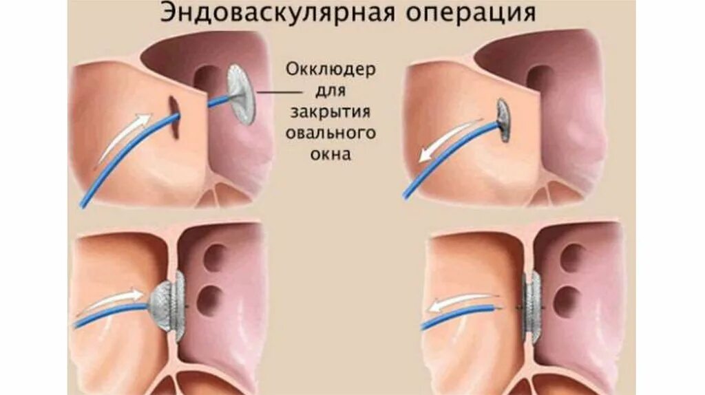 1 3 окно в сердце. Открытое овальное окно. Окклюдер кардиологический. Порок сердца открытое овальное окно.