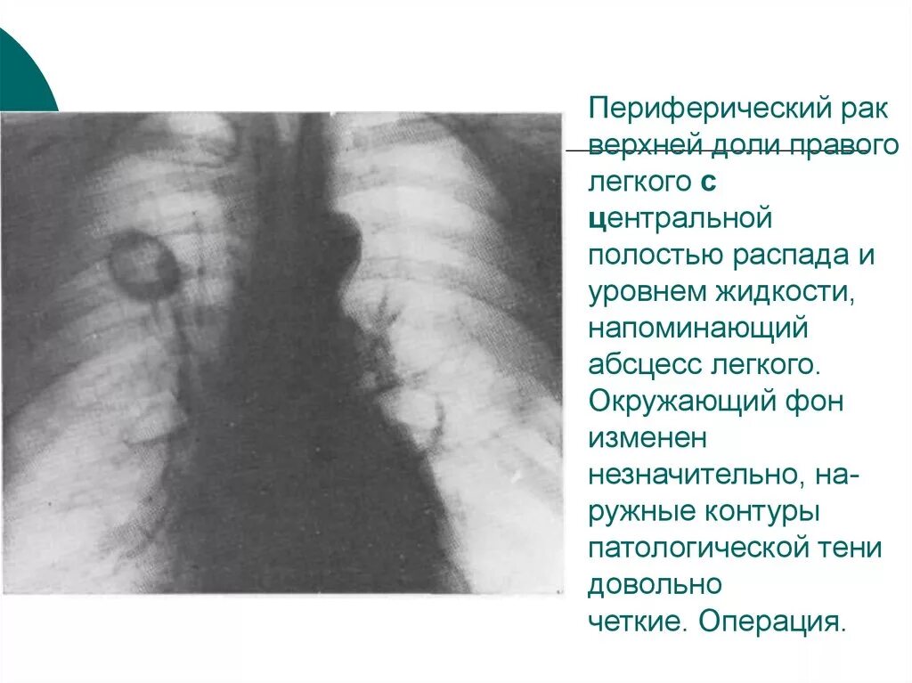 Периферическая опухоль верхней доли правого легкого. Периферическая в1 верхней доли левого легкого. Периферическая опухоль верхней доли правого легкого кт. Периферическое образование верхней доли правого легкого. Образование верхней доли левого легкого