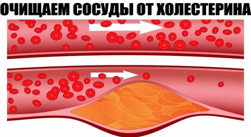 Чем чистить холестериновые бляшки. Холестериновые бляшки в сосудах сердца. Как очистить сосуды от холестериновых. Как убирают бляшки в сосудах. Как избавиться от бляшек в сосуде.