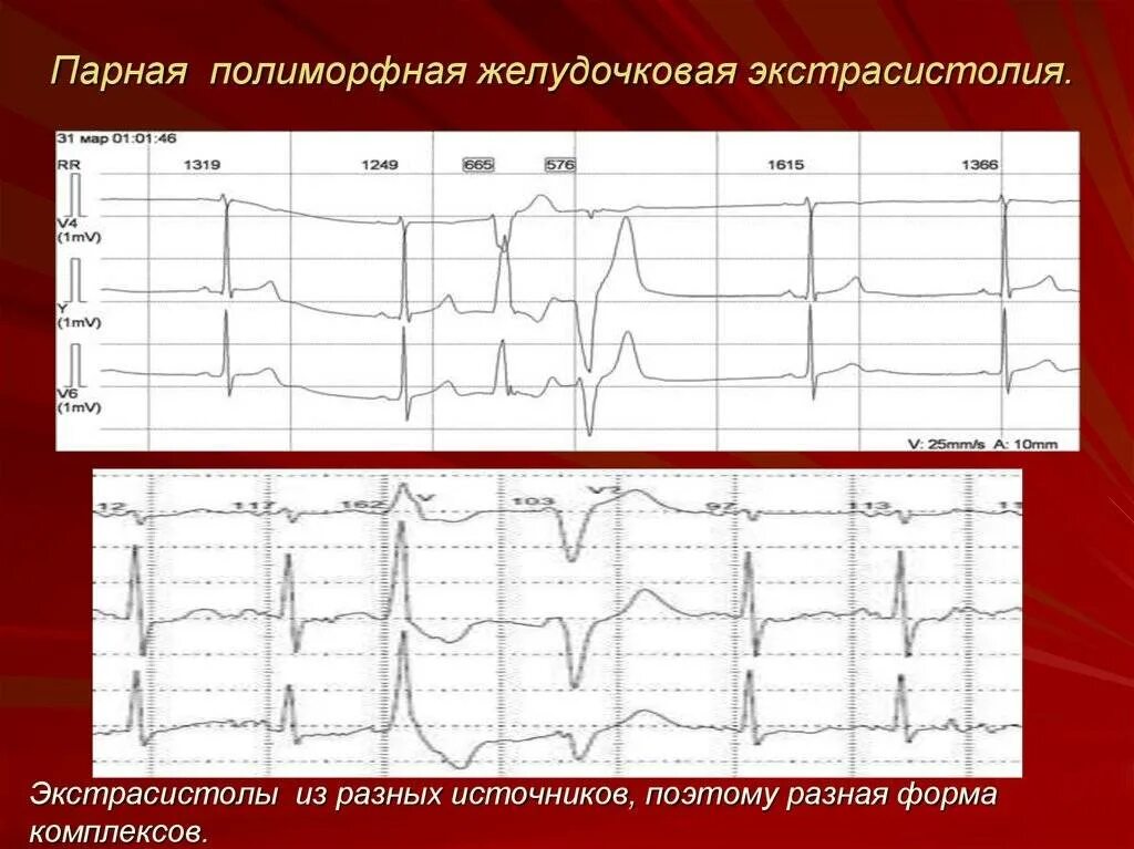 ЭКГ монотопные желудочковые экстрасистолы. Политопная желудочковая экстрасистолия на ЭКГ. Полиморфная желудочковая экстрасистолия на ЭКГ. Мономорфная желудочковая экстрасистолия на ЭКГ. Политопные экстрасистолы