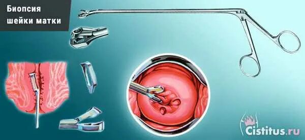 Ножевая биопсия. Инструмент для забора биопсии шейки матки. Аппарат для взятия биопсии шейки матки. Прицельная биопсия шейки.