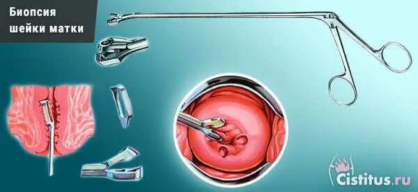 Инструмент для забора биопсии шейки матки. Аппарат для взятия биопсии шейки матки. Прицельная биопсия шейки.