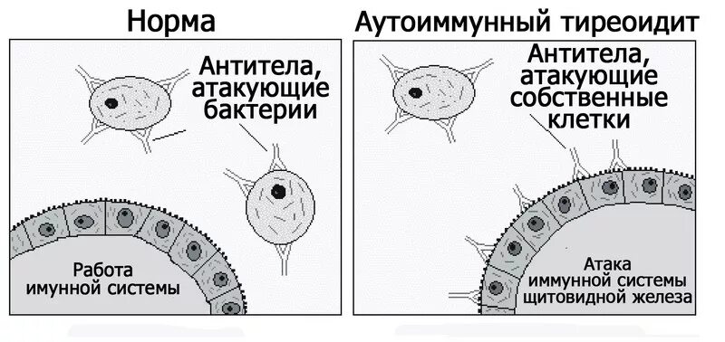 Аутоиммунные изменения щитовидной. Тиреоидит Хашимото патогенез. Аутоиммунный тиреоидит щитовидной железы что это такое. Заболевание щитовидной железы тиреоидит. Симптомы тиреоидита щитовидной железы.