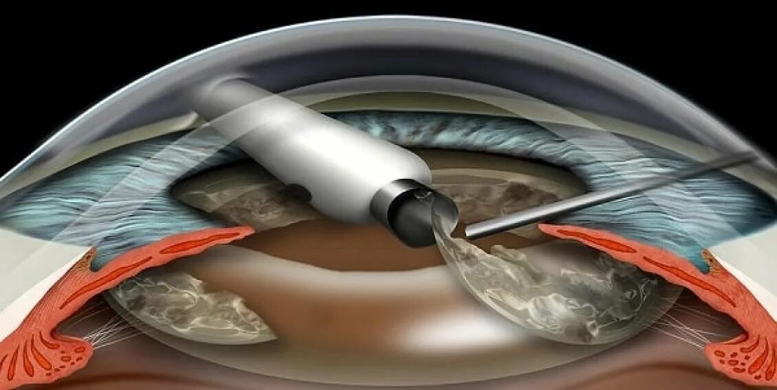 Искусственно расширенный. Катаракта факоэмульсификация. Операция ультразвуковая факоэмульсификация катаракты. Факоэмульсификация катаракты этапы операции. Факоэмульсификация с имплантацией ИОЛ.