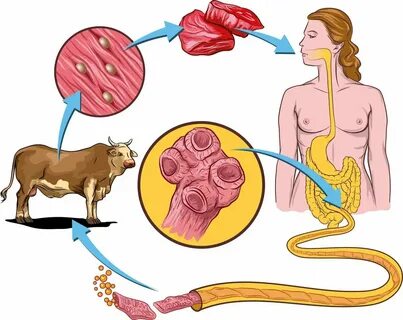 Заражение человека финнами