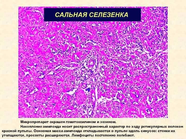 Саговый амилоидоз селезенки. Саговый амилоидоз селезенки