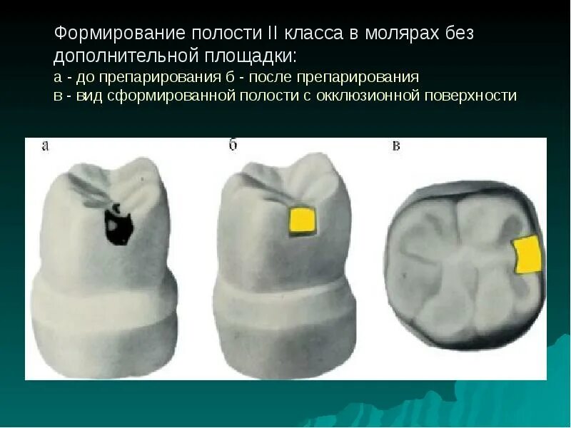 Препарирование зуба по блэку. Классы кариозных полостей по блэку. препарирование полостей 3 класса по блэку. препарирование кариозных полостей 1 класса по блэку. кариозные полости 2 класса по блэку.