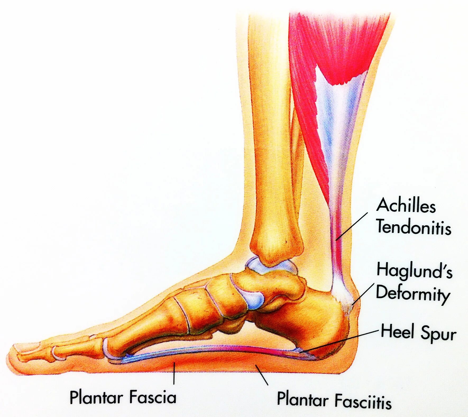 Почему болят сухожилия пятки. Ахиллесово сухожилие анатомия. Плантарный фасциит (подошвенный фасциит).
