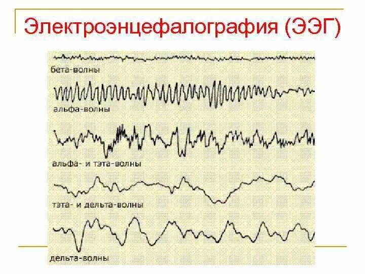 Альфа и бета ритмы на ЭЭГ. Волны Альфа ритм ЭЭГ. Дельта волны на ЭЭГ. Альфа бета волны на ЭЭГ.