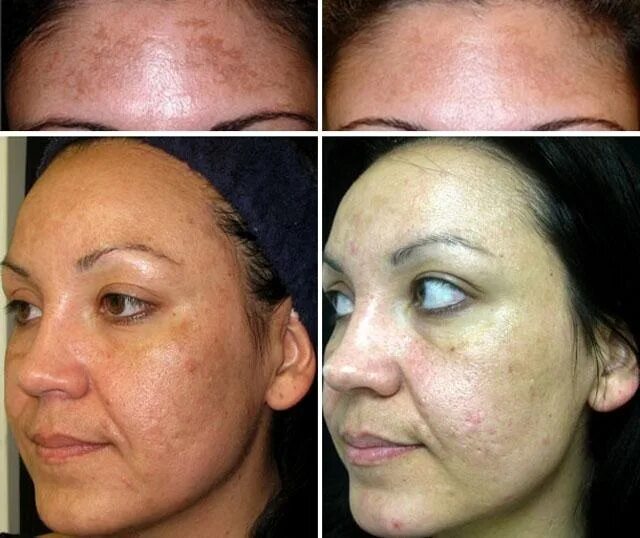 Лазерная шлифовка кожи цена skinlift ru. Фракционный лазерный термолиз со2. Лазерный пилинг фраксель. Фракционное неабляционное омоложение. Шлифовка лазером кожи лица.