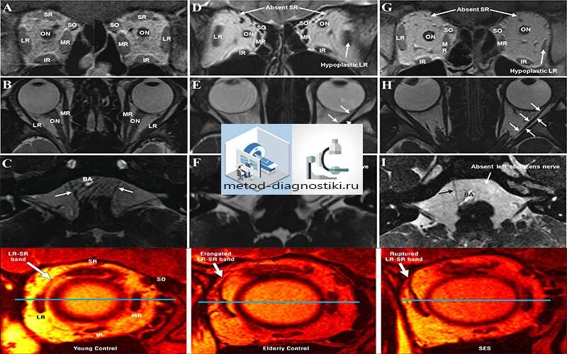 Мрт глазного нерва. Мрт глазницы и зрительного нерва. Магнитно-резонансная томография орбит. Мрт орбит и зрительных нервов. Мрт головного мозга и глазных орбит.