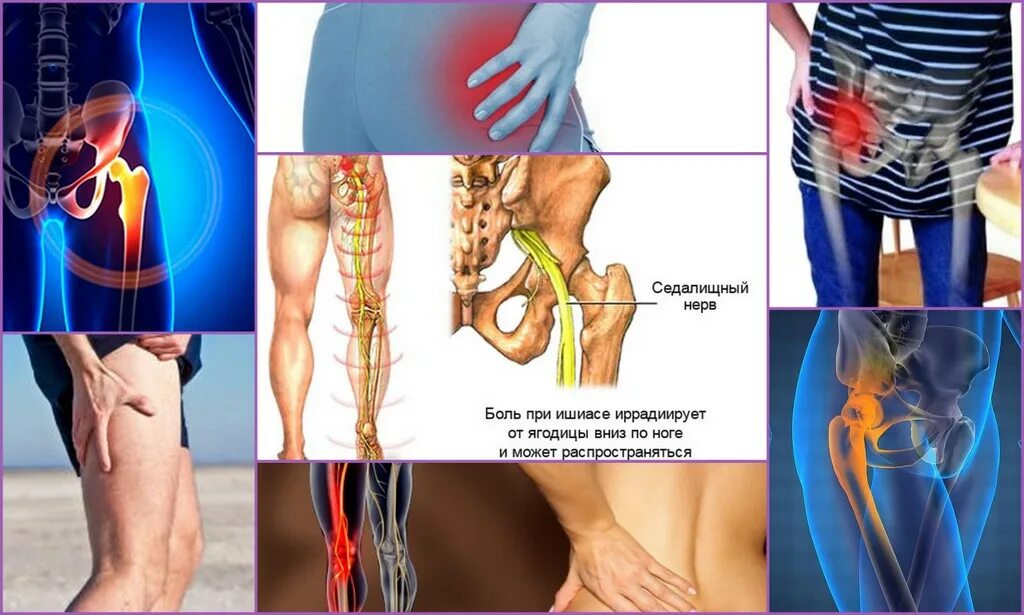 Седалищный нерв в области бедра. Тазобедренный сустав седалищный нерв. Седалищный нерв левая нога. Проекция седалищного нерва.