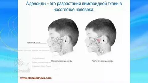 Аденоиды у ребенка 3 степени удалять
