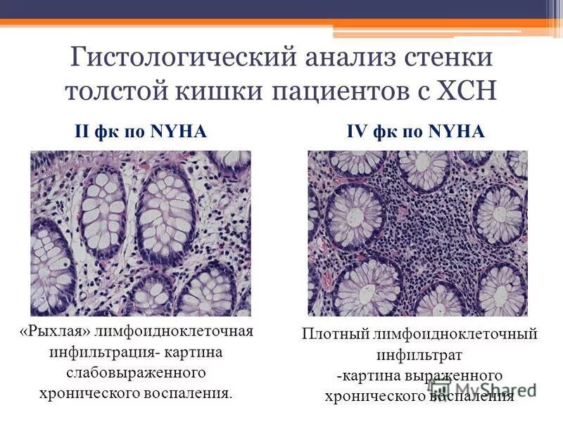лейкоцитарная инфильтрация печени. слабовыраженная инфильтрация. значительная лейкоцитарная инфильтрация. строение дна желудка гистология. аутоиммунный гепатит патогенез.