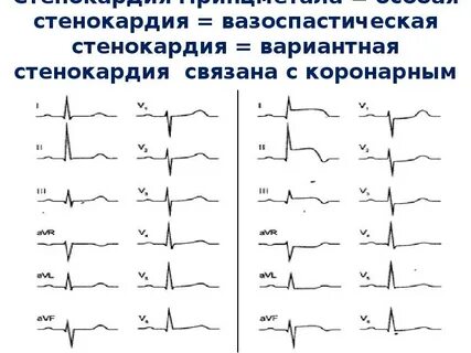 Стенокардия на экг