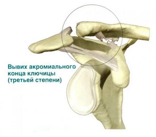 Вывих акромиально ключичного сочленения. Вывих акромиального конца ключицы. повреждение связок акромиально ключичного сустава. вывих акромиально-ключичного сустава рентген. разрыв связок ключично-акромиального сочленения.