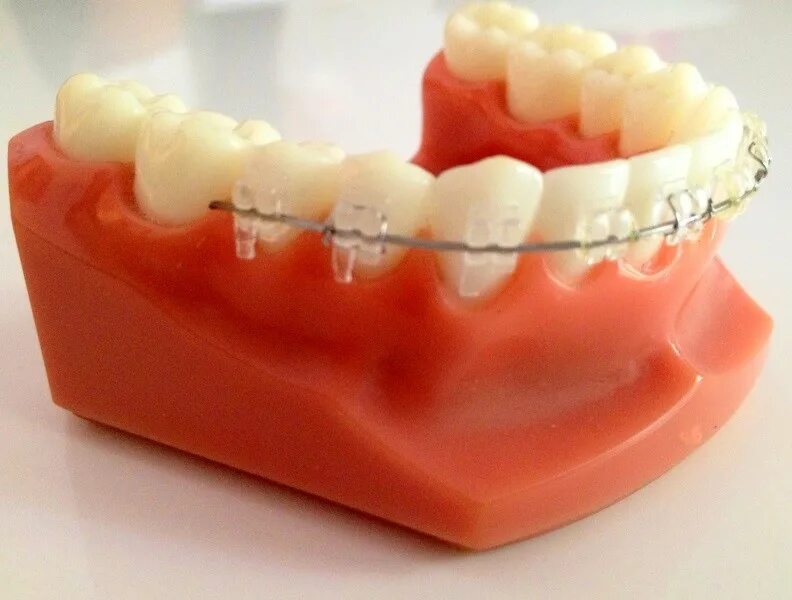 сапфировые брекеты лигатурные. керамические лигатурные брекеты. брекеты самолигирующие damon clear (керамические ormco. керамические брекеты american orthodontics. сапфировые брекеты лигатурные.