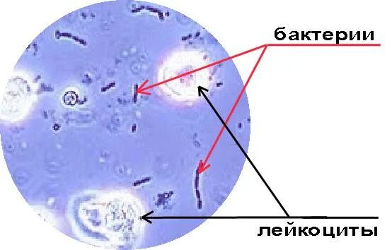 Высокие бактерии в моче. Бактерии в моче микроскопия. Бактериурия микроскопия. Микроскопия осадка мочи бактерии. Лейкоциты и бактерии в моче.