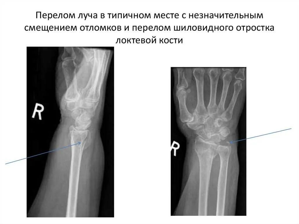 Перелом луча в типичном месте мкб. Перелом дистального метаэпифиза шиловидного отростка лучевой кости. перелом шиловидного отростка рентген. перелом шиловидного отростка локтевой кости рентген. перелом шиловидного отростка локтевой кости со смещением.