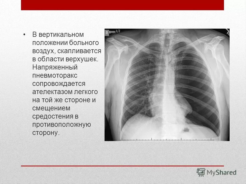 синдром скопления воздуха в плевральной полости. пневмоторакс при ранении грудной клетки. скапливается воздух в легких. левосторонний пневмоторакс. скапливается воздух в легких.