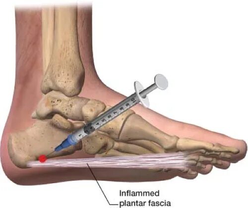 Некротизирующий фасциит. Стрептококковый некротизирующий фасциит. Дипроспан блокада плантарного фасцида. Внутримышечная блокада пяточной шпоры.