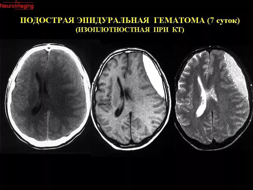 Черепно мозговые гематомы. Субдуральная гематома мрт мрт. Субдуральная и эпидуральная гематома кт. Подострая субдуральная гематома мрт.