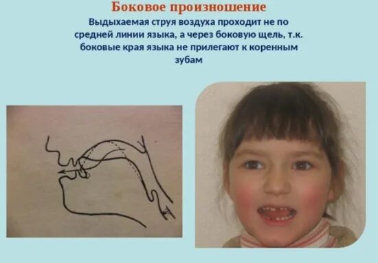 Боковой звук р. Боковой сигматизм свистящих. коррекция бокового сигматизма свистящих. боковой сигматизм шипящих звуков. боковой сигматизм звука с.