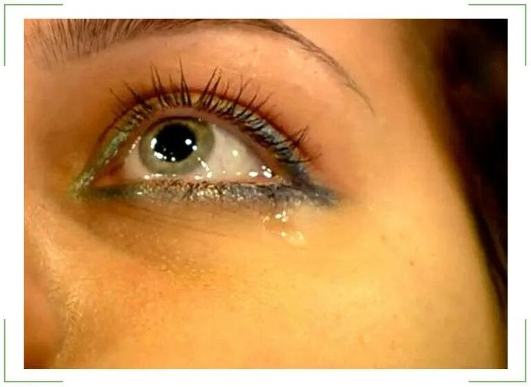 Птеригиум глазные капли. Заплаканные голубые глаза. Крыловидная плева (птеригиум). На глазу как будто пленка. На глазу как будто пленка.