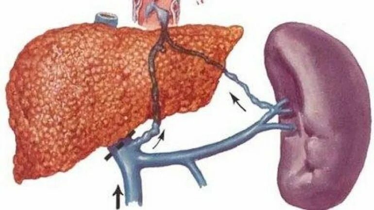 Печень почки легкие селезенка. Портальная гипертензия селезенки. Цирроз печени гепатолиенальный синдром. Портальный цирроз печени. Спленомегалия..