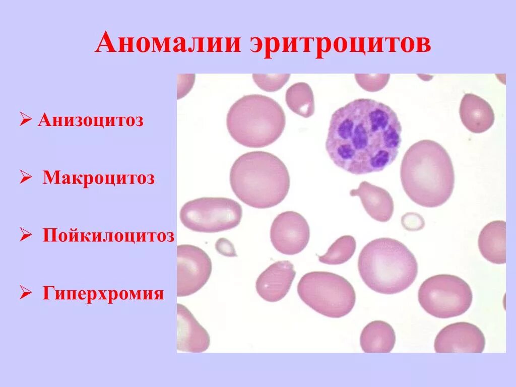 Пойкилоцитоз эритроцитов это. Анизоцитоз пойкилоцитоз микроцитоз. пойкилоцитоз формы эритроцитов. макроцитоз анизоцитоз пойкилоциьоз. анизоцитоз пойкилоцитоз полихроматофилия.