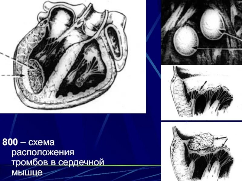 Тромбоз в полостях сердца. Шаровидные тромбы в полости сердца. Наличие тромба в полостях сердца.. Сердечный тромбоз