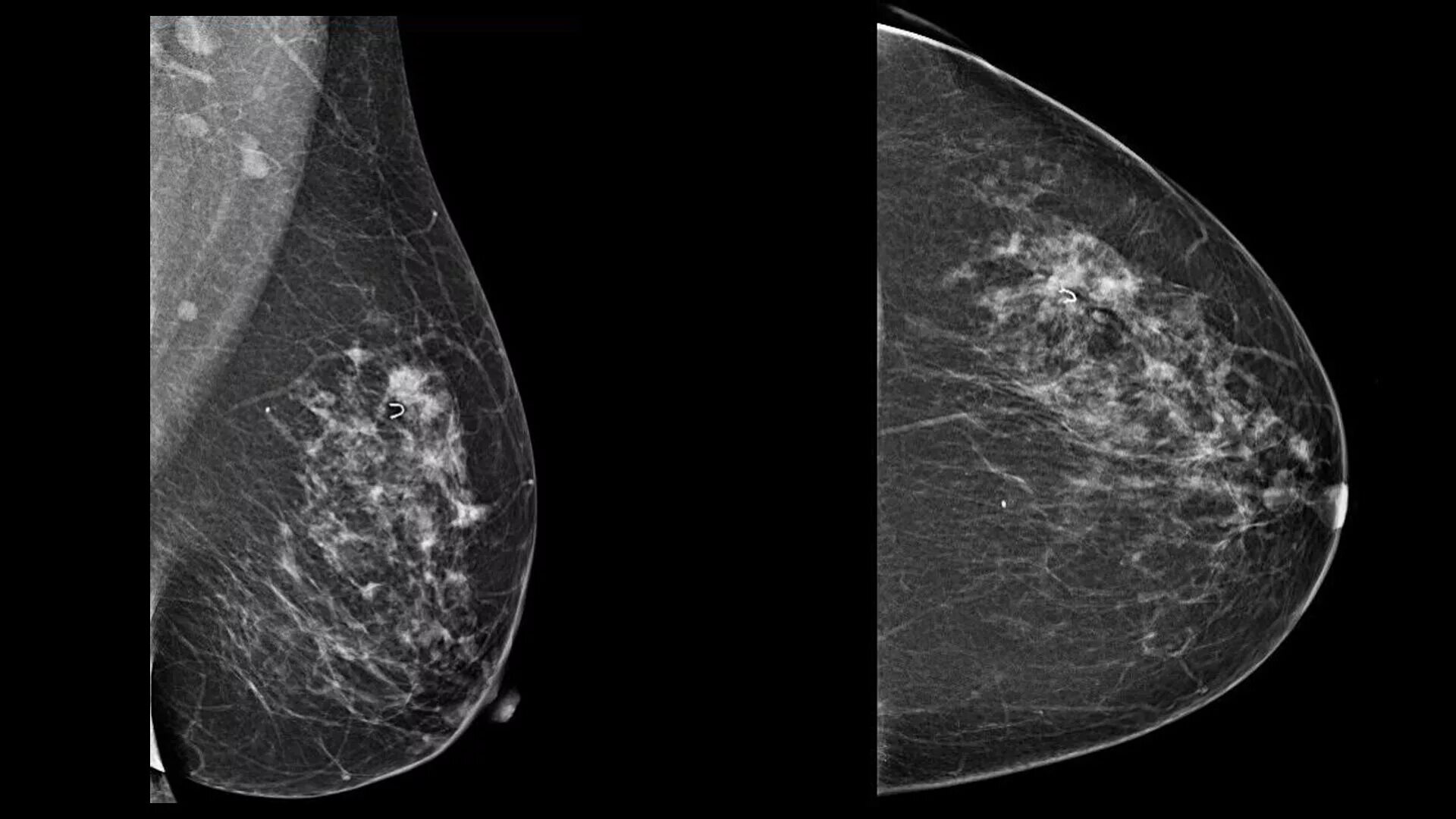 Округлые образования в молочной железе. Рик молочной железы маммографич. Молочная железа маммография. Мастопатия на маммографии. Маммография рентген молочной железы.