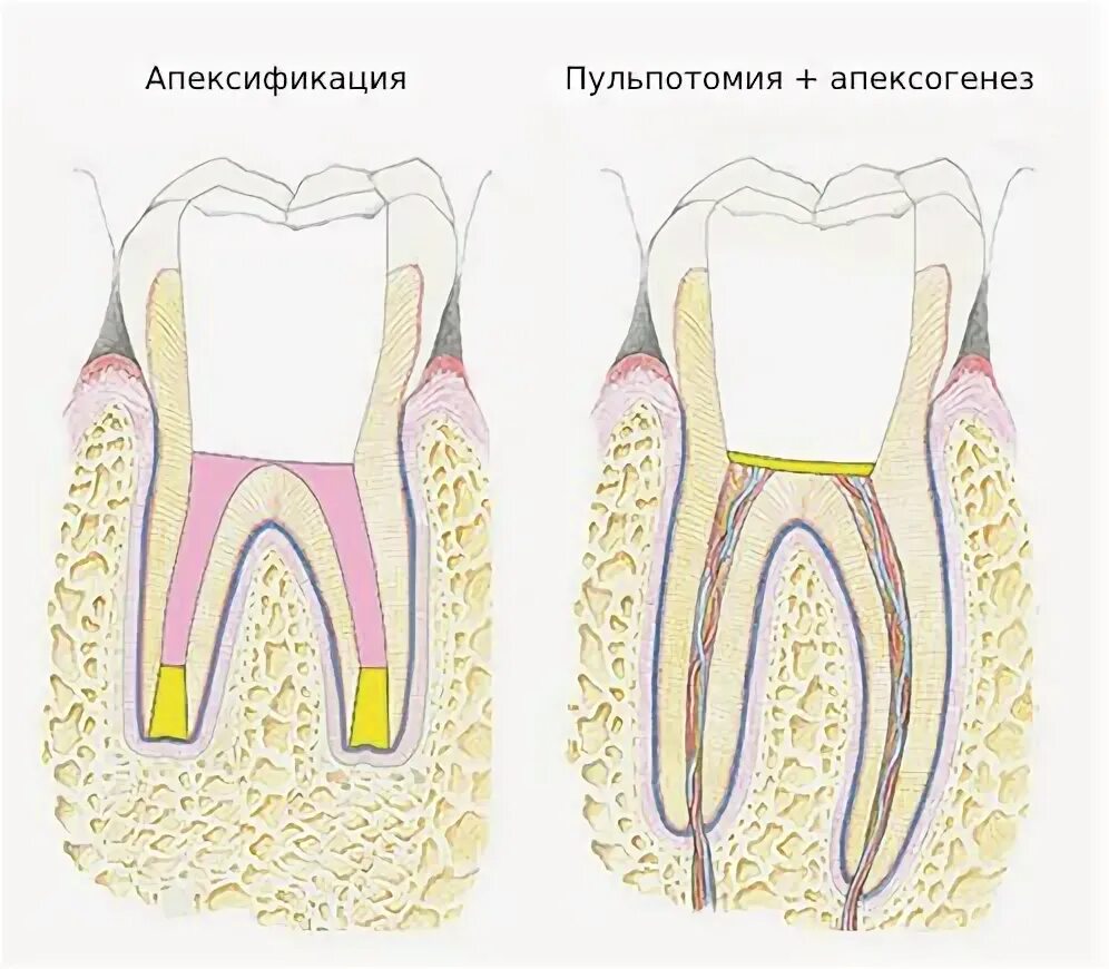 Лечение пульпита с несформированными