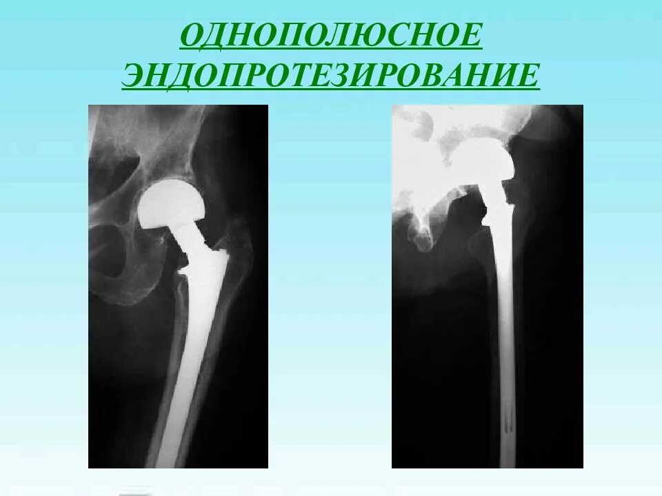 Эндопротезирование шейки бедренной кости. Однополюсное эндопротезирование тазобедренного сустава рентген. Тотальное и однополюсное эндопротезирование тазобедренного сустава. Межвертельный перелом бедренной кости. Осложнения после эндопротезирования тазобедренного сустава