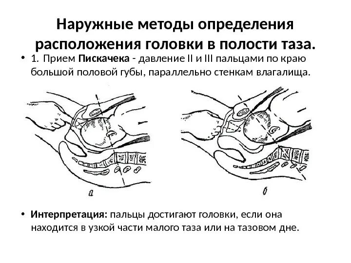 По Пискачеку метод определения головки. Метод Пискачека в родах алгоритм. Определение продвижения головки методом Пискачека. Продвижение головки плода методом Пискачека.