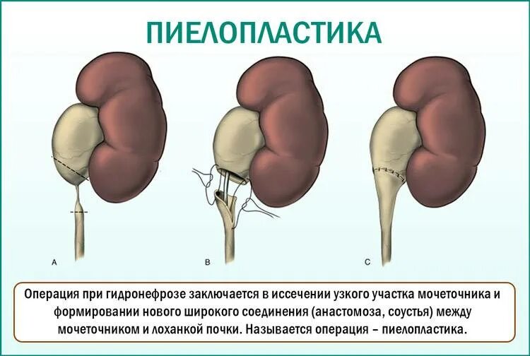 Пиелопластика по Хайнсу-Андерсену. Лапароскопическая пиелопластика. Диагноз гидронефроз почки. Операция почки гидронефроз пластика. Резекция почки что это