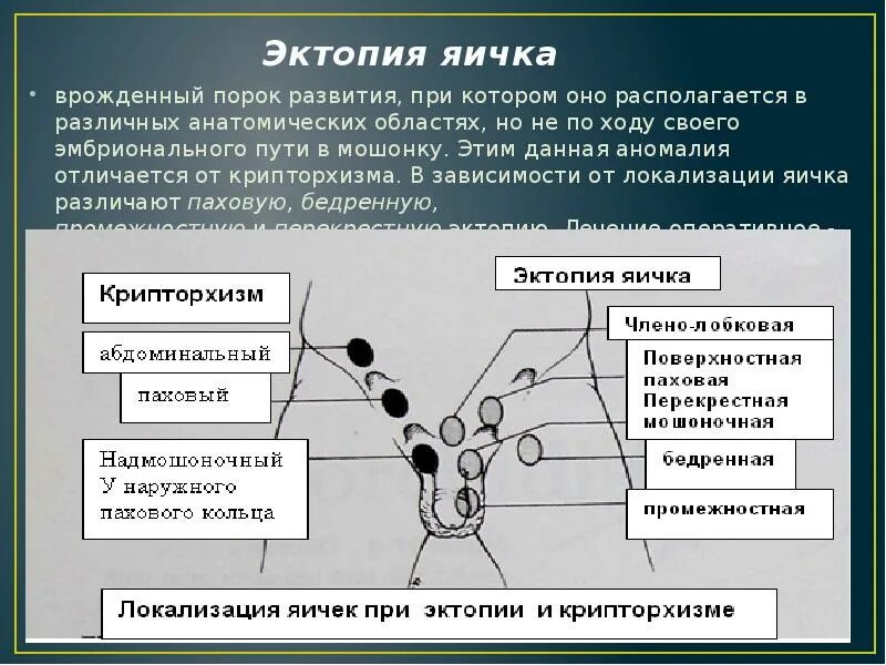 Крипторхизм классификация. Классификация крипторхизма у детей. Эктопия яичка классификация.