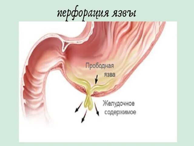 Перфоративная язва ДПК. Прободная язва ДПК клиника. Пенетрация язвы желудка. Перфоративная язва желудка и 12-перстной кишки. Перфоративная язва симптомы