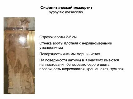Сифилитический мезаортит