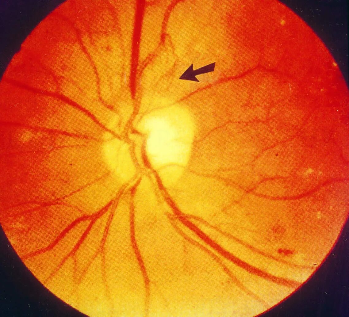 Препролиферативная ретинопатия. Транзиторная диабетическая ретинопатия. Жидкость в сетчатке