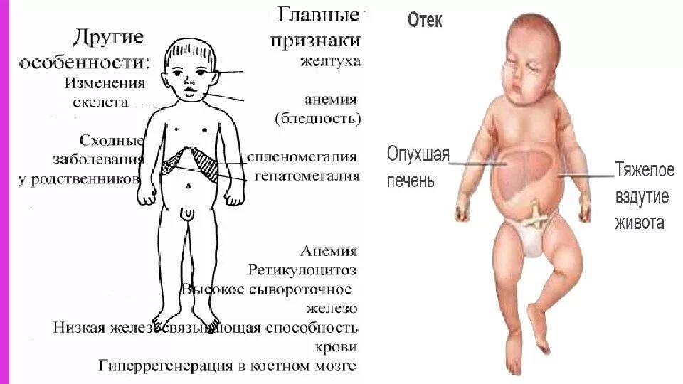 Реактивная печень у ребенка. Увеличена печень и селезенка у ребенка 2 года. Симптомы увеличения печени и селезенки у ребенка 2 года. Поражение печени симптомы у ребенка. Больная печень у грудничка симптомы.