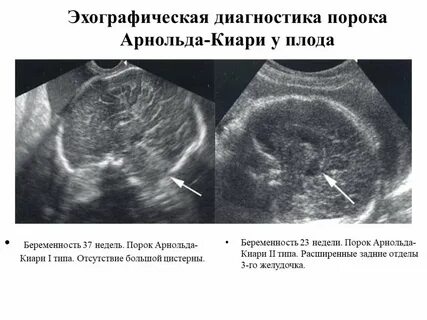 Пороки плода на узи