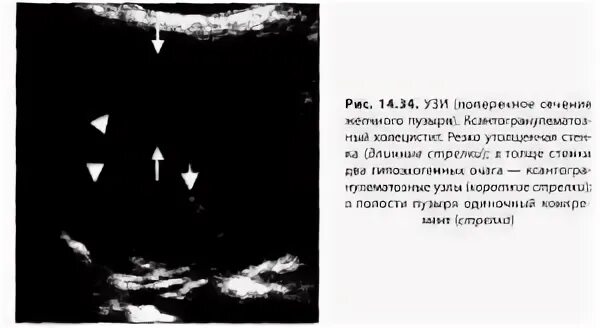 Холестероз стенок желчного пузыря. Сетчатая форма холестероза УЗИ. Холестероз желчного УЗИ.