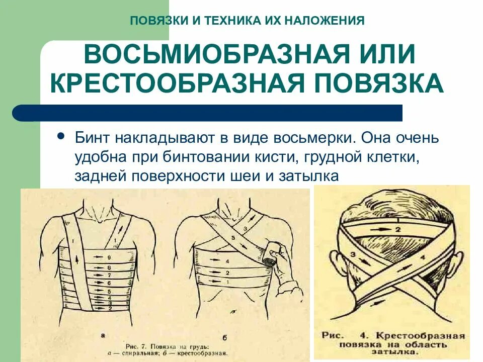 Повязка на грудную клетку алгоритм. Крестообразная (восьмиобразная) повязка. Типы повязок восьмиобразная. Крестообразная бинтовая повязка. Бинтовые повязки: • крестообразная (восьмиобразная.