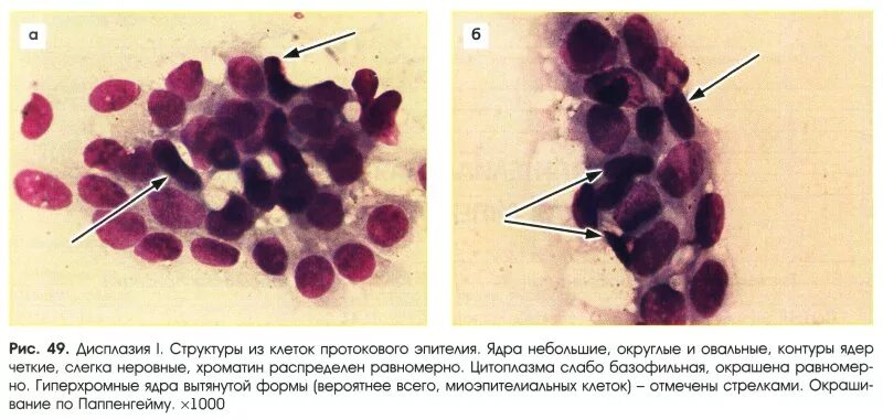 Дисплазия 2 степени цитология. Дисплазия эпителия гистология. Дисплазия эпителия гистология. Эпителий шейки матки гистология. Дисплазия шейки матки цитология.
